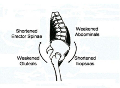 Lower Cross Syndrome
